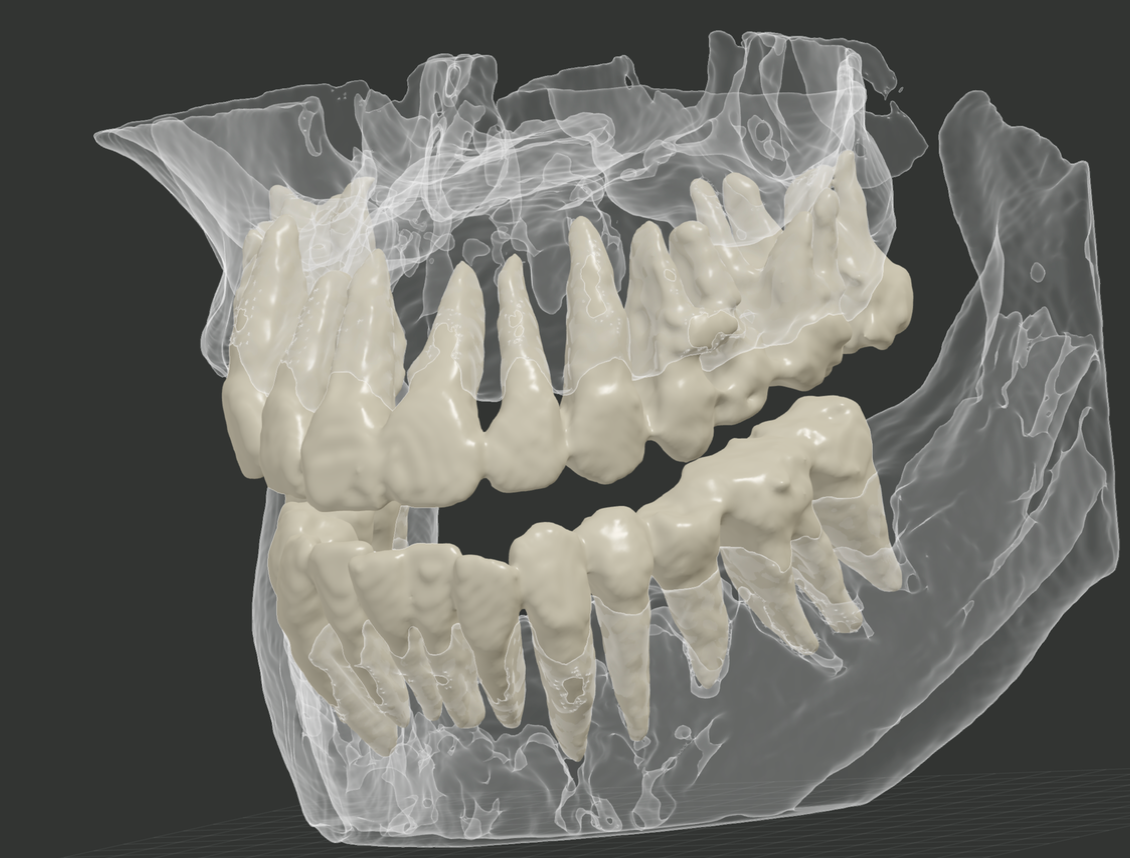 DentalSegmentatorで作成した顎骨と歯をX-ray表示した結果