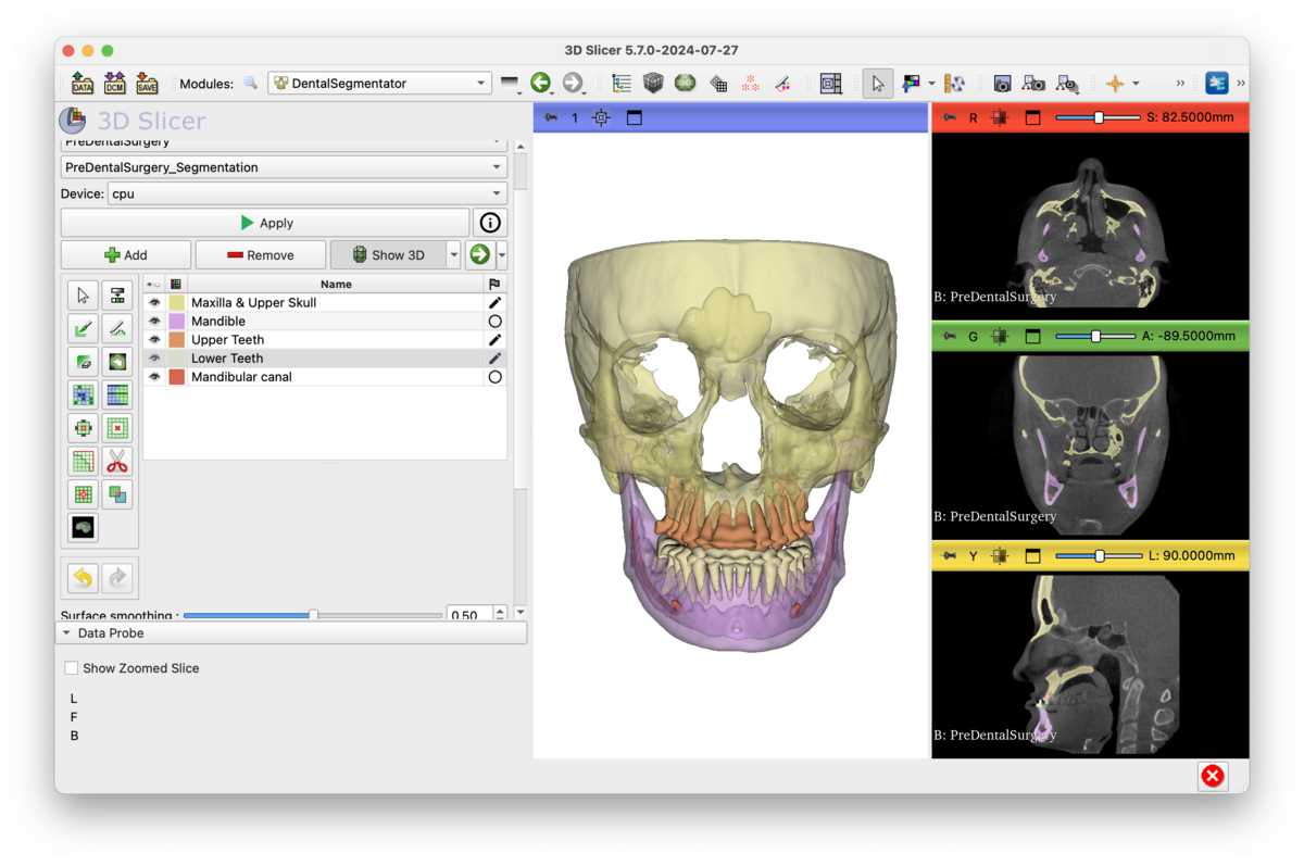 旧記事に掲載した3D SlicerのDentalSegmentator画面
